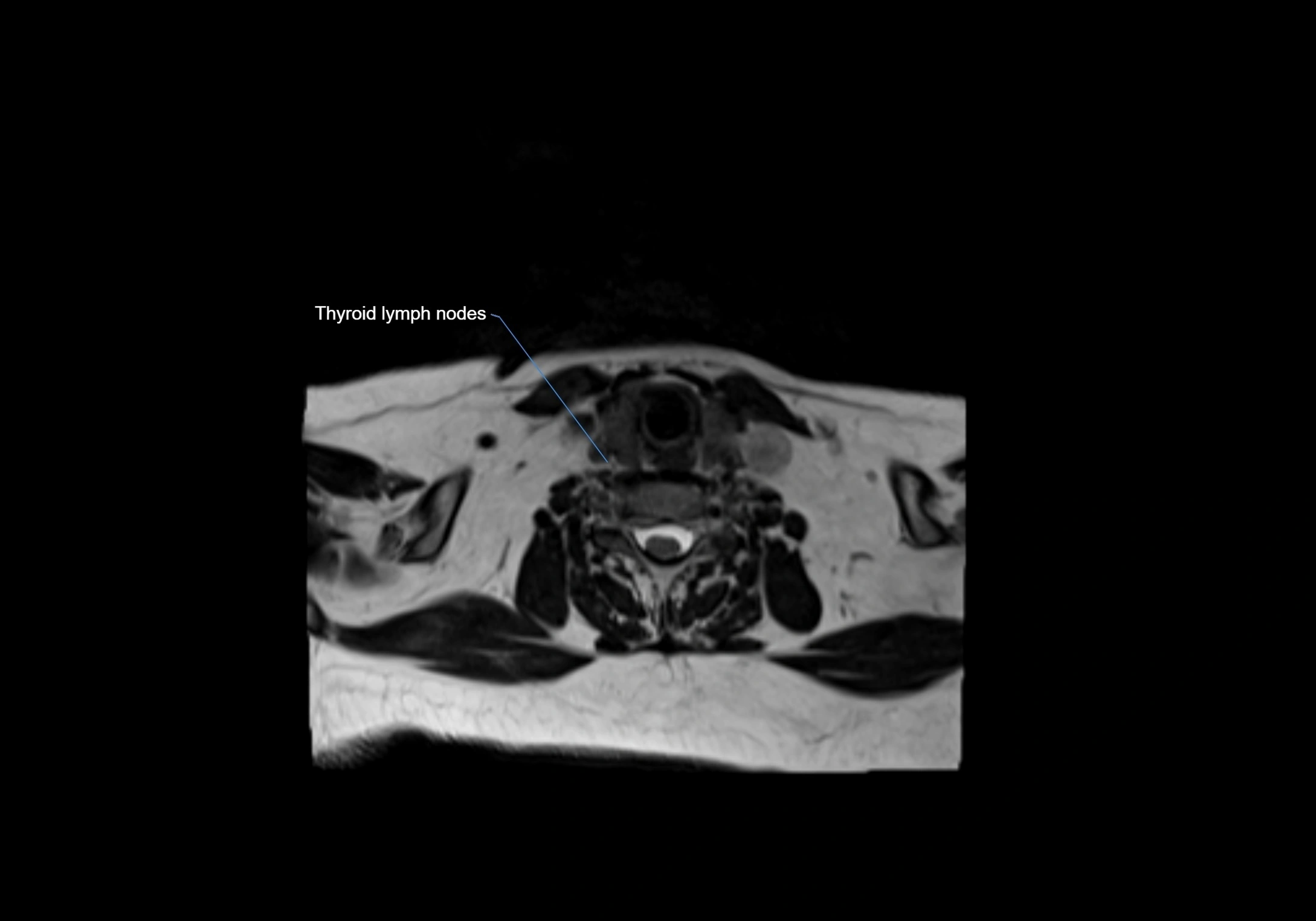 Neck axial  lymph node cross sectional MRI anatomy 3T MRI  image-img-00001-00075.webp